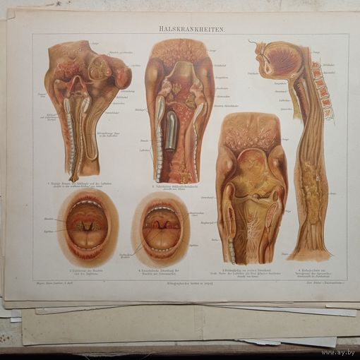 HALSKRANKHEITEN. Литография Германия. Гравюра середина 19века 30x24см. РАСПРОДАЖА КОЛЛЕКЦИИ.
